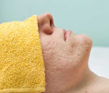 Effectiveness of Acen Treatment from Jupiter, FL dermatologist