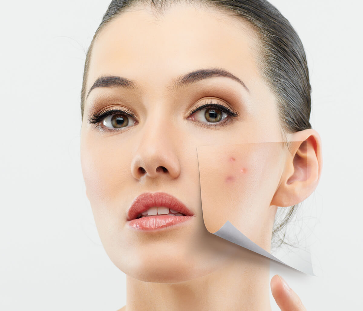 What Options Are Available for Treatment of Acne in Jupiter, Florida Area?