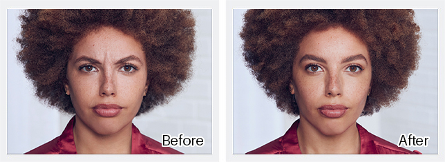 Botox Before & After Results