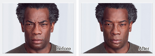 Botox Before & After Results