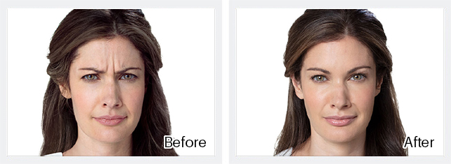 Botox Before & After Results