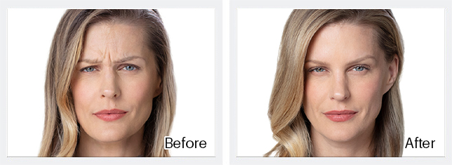 Botox Before & After Results