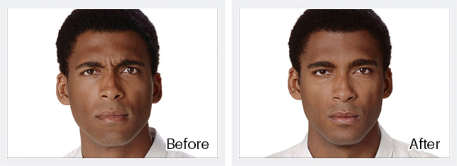 Botox Before & After Results