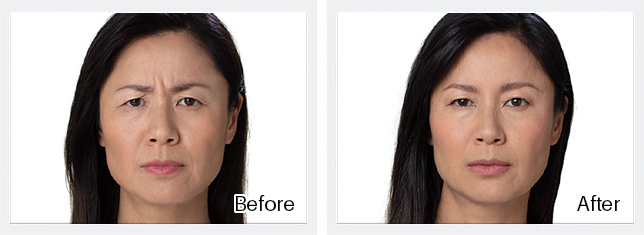 Botox Before & After Results