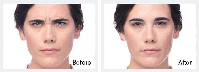 Dysport Before & After Results