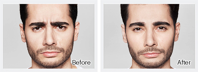 Dysport Before & After Results