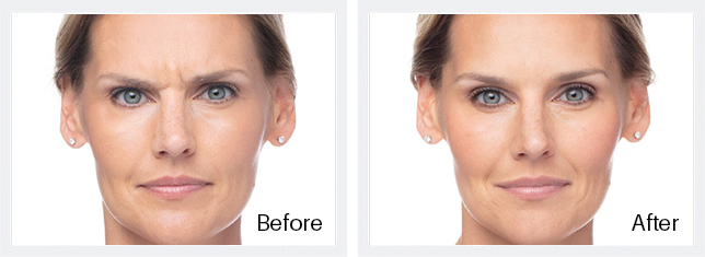 Dysport Before & After Results