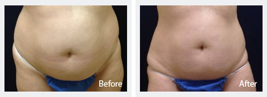 How to Get a Flat Tummy: Tummy Tuck vs. Liposuction vs. SculpSure