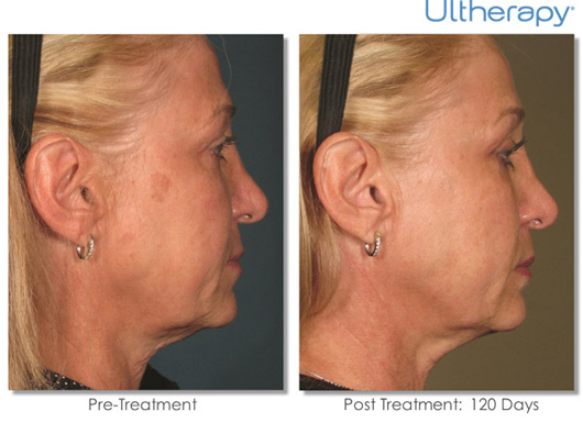 Ultherapy Before & After Results