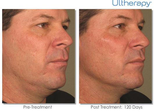Ultherapy Before & After Results