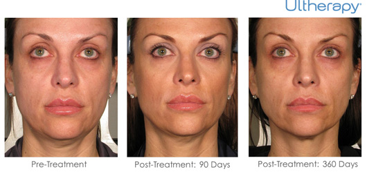 Ultherapy Before & After Results