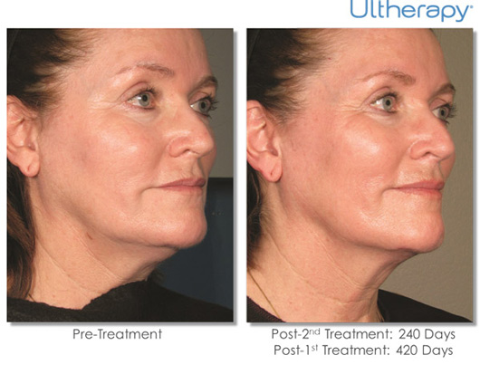 Ultherapy Before & After Results