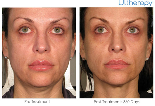 Ultherapy Before & After Results