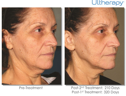 Ultherapy Before & After Results