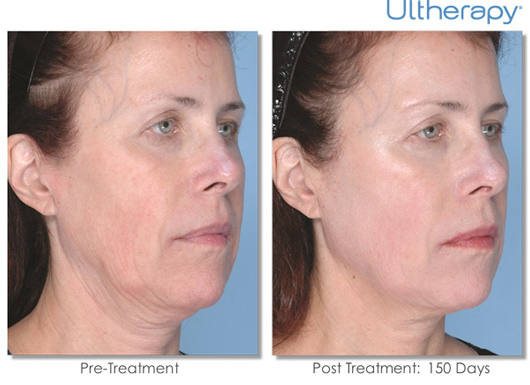 Ultherapy Before & After Results