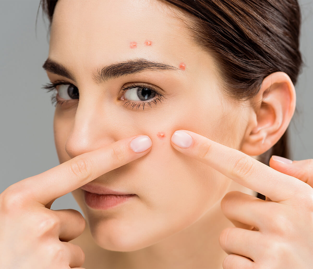 Hormonal Acne Breakout Treatment in Jupiter Florida Area