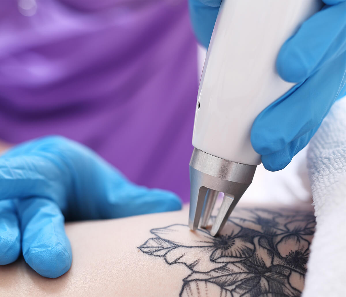 Laser Tattoo Removal Cost in Jupiter FL Area