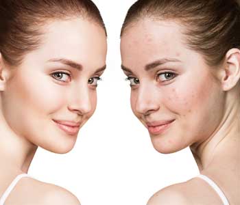 Medication for Acne in FL- What Are the Symptoms of Acne