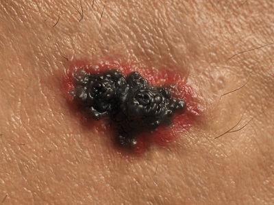 Melanoma Cancer Treatment from Jupiter, FL dermatologist