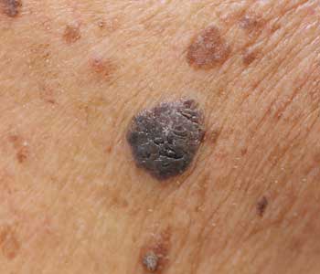 Skin Cancer Melanoma 