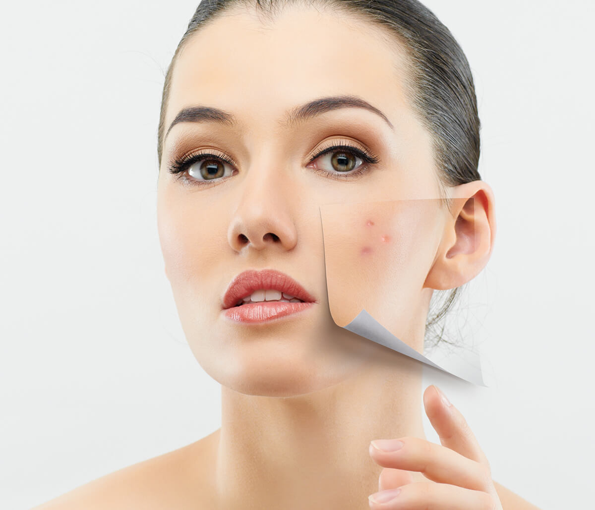 Treatment for Acne in Jupiter, FL Area